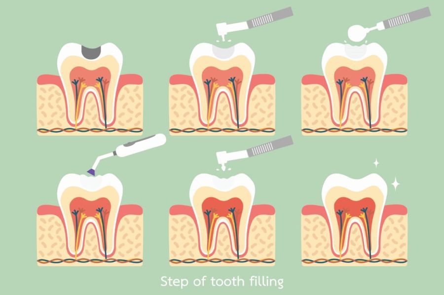 dentlfilling3