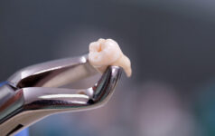 extractii-dentare