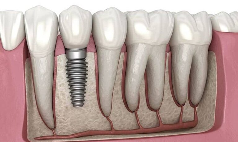 Cum îți pot schimba viața implanturile dentare – Ghidul tău de la un dentist de top din Arad