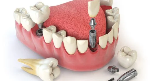 DCR dentar